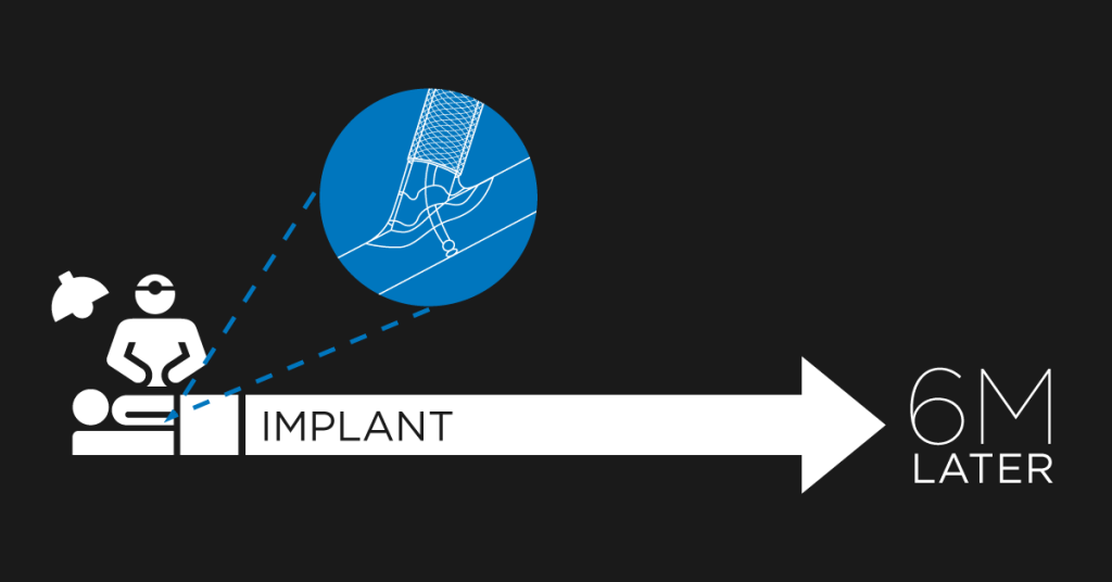 AV fistula construction with VasQ™ A Pilot Study