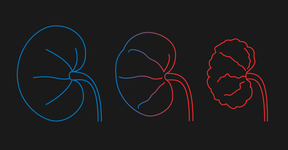 renal failure treatment