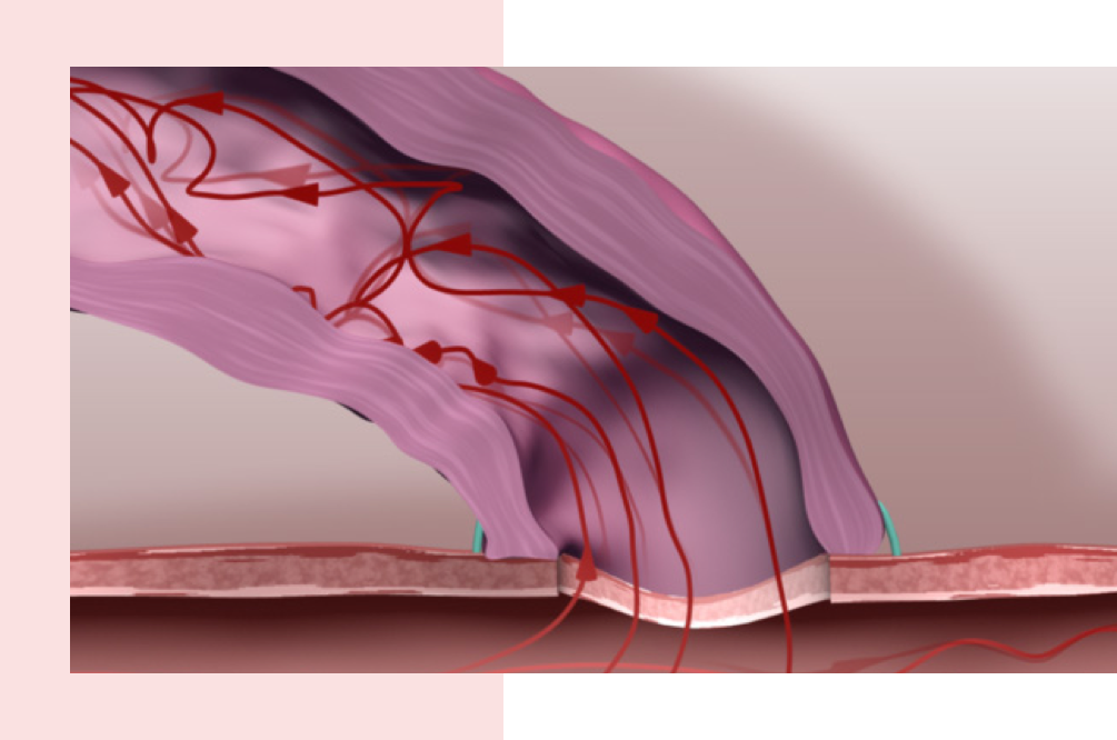 VasQ Laminate Medical