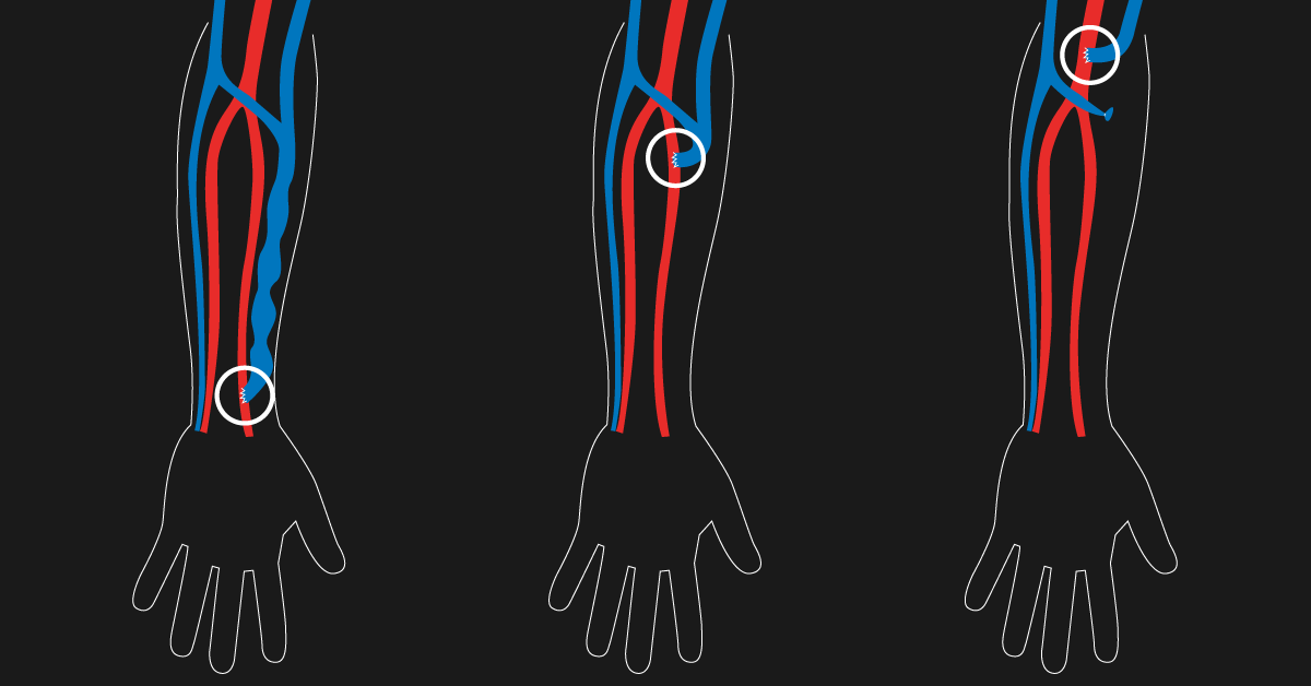 Fistula Types